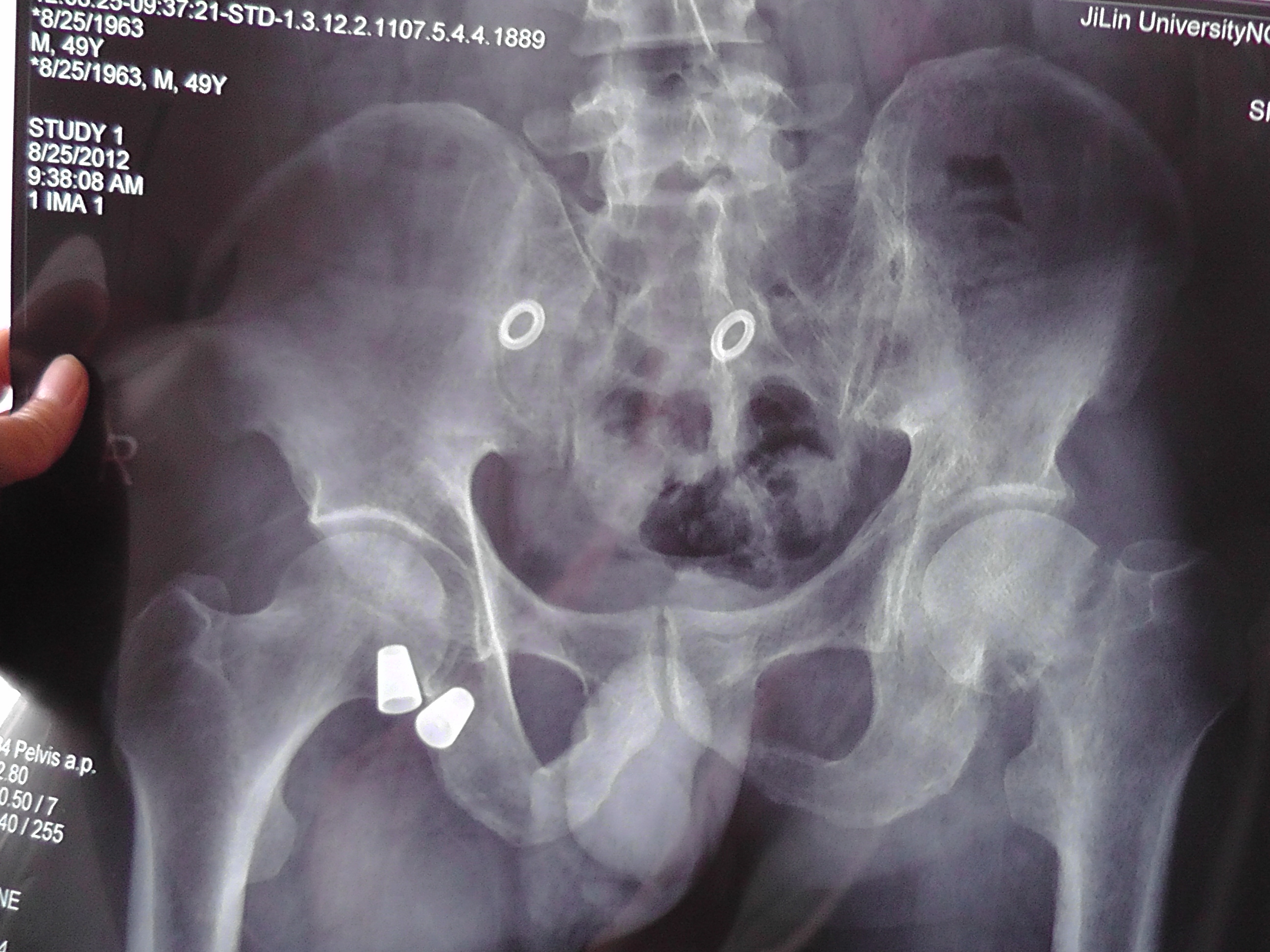 锁骨骨折错位折断。现在没有手术只是保守治疗