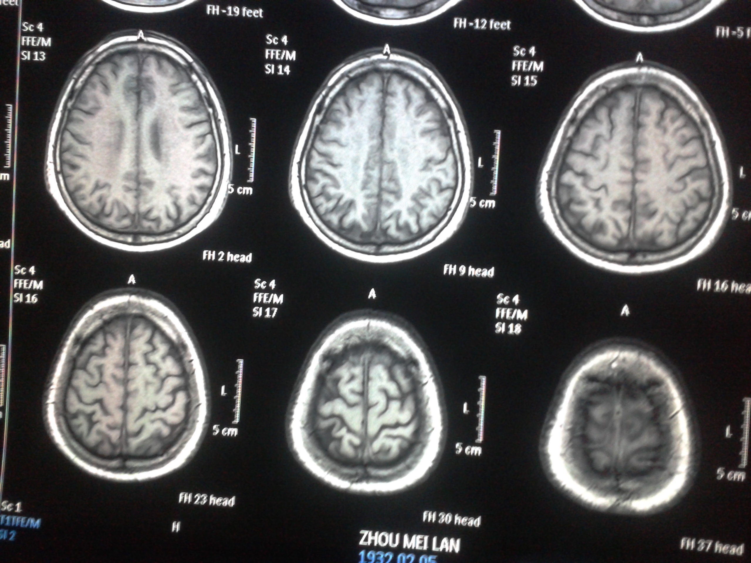 多发腔隙性脑梗塞.脑白质变性.老年性脑萎缩要