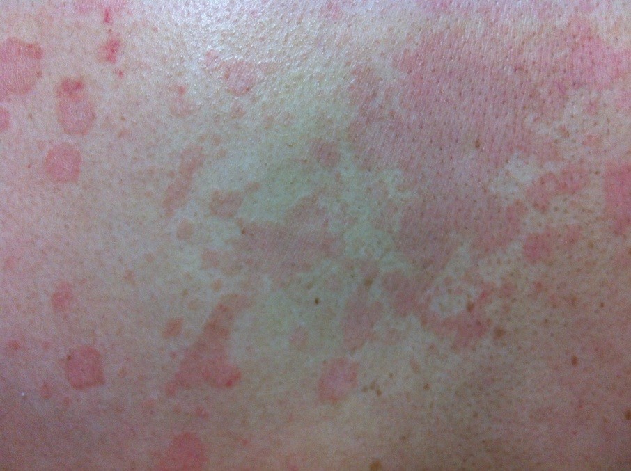 光动力激光能根治大面积鲜红斑治吗?以现在医