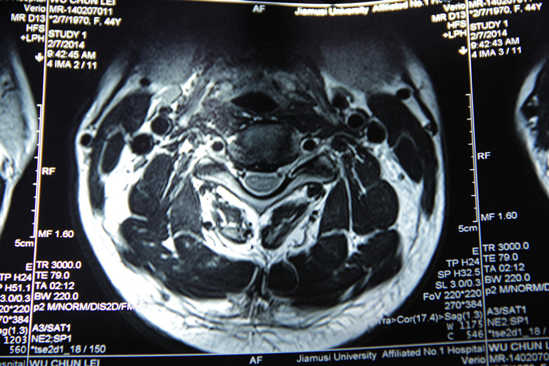 颈椎C3-C4,C4-C5,C5-C6层面椎间盘向后突出