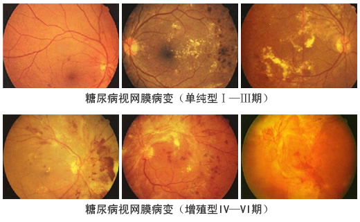 糖尿病患者应及早行眼底筛查避免视力损害-健康之路健康知识