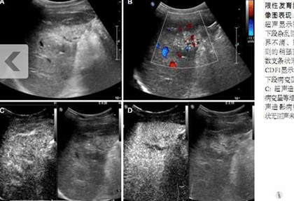 肝脏超声造影的优点及局限性探讨(附60例临床分析)