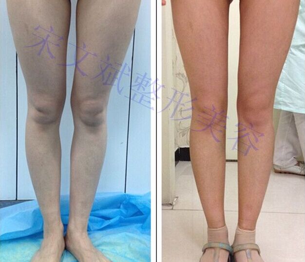 O型腿自体脂肪矫正-医生交流分享-寻医问药-xywy.com