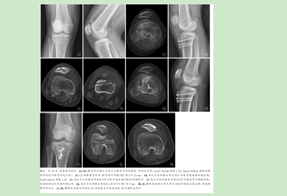 右膝复发性髌骨脱位内侧髌股韧带重建术后翻修1例-医生交流分享-寻医问药-xywy.com
