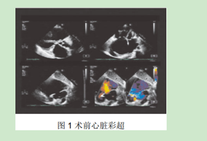 鲁登巴赫综合征合并多瓣膜联合病变外科治疗1例