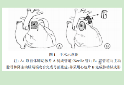 应用肺动脉管道矫治主动脉弓离断后管道重度扩张一例