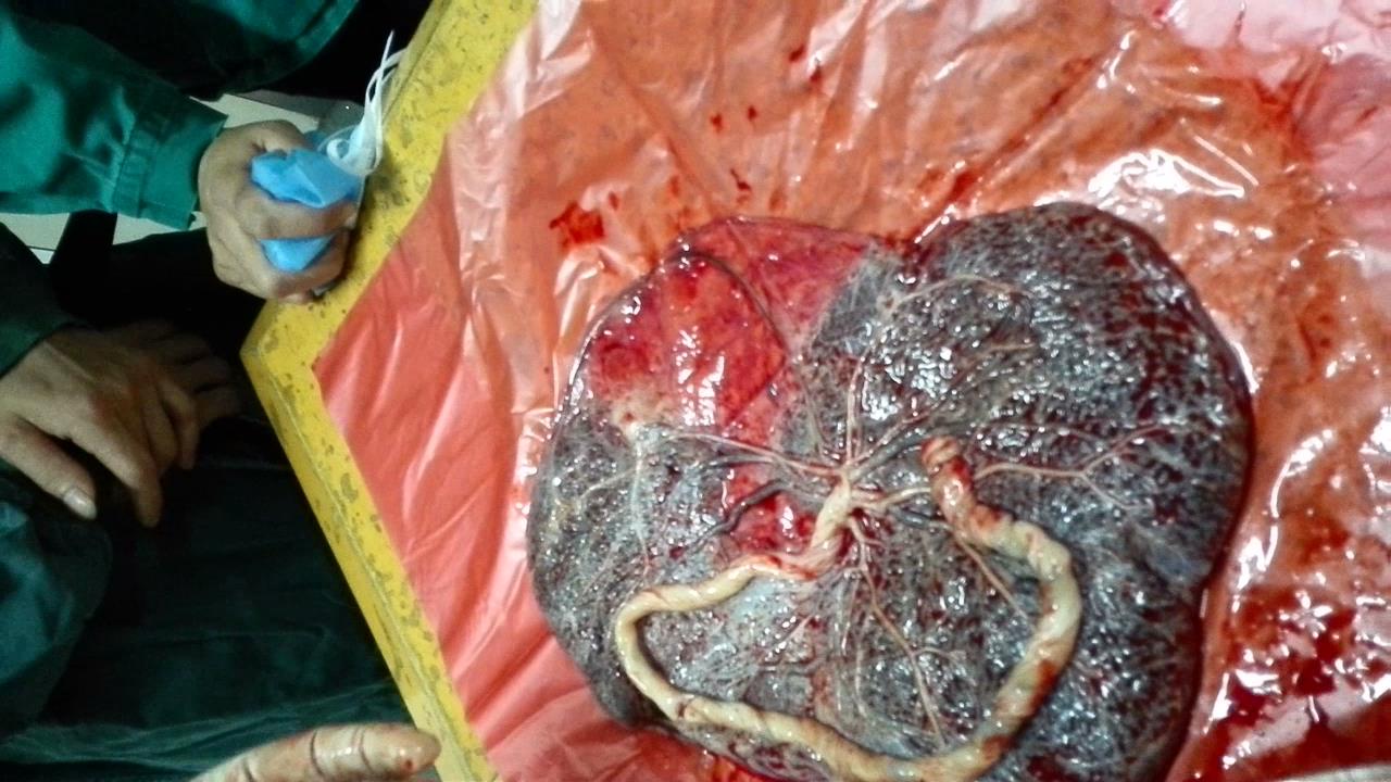 前置血管破裂致胎儿死亡案例-医生交流分享-寻医问药-xywy.com