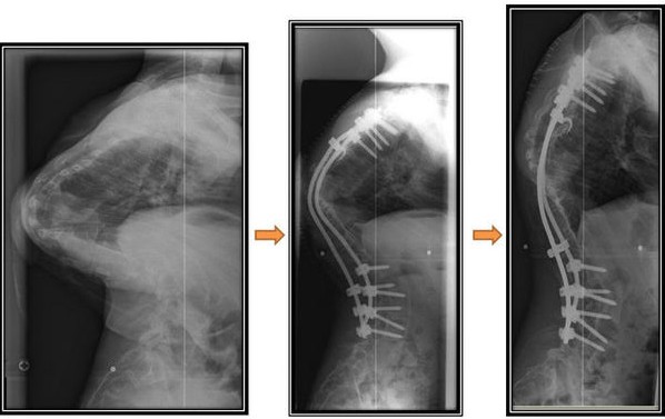 脊柱侧弯典型病例-脊柱后凸(驼背)
