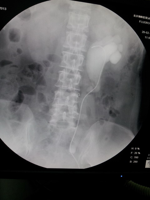极度迂曲扩张输尿管置双j管术