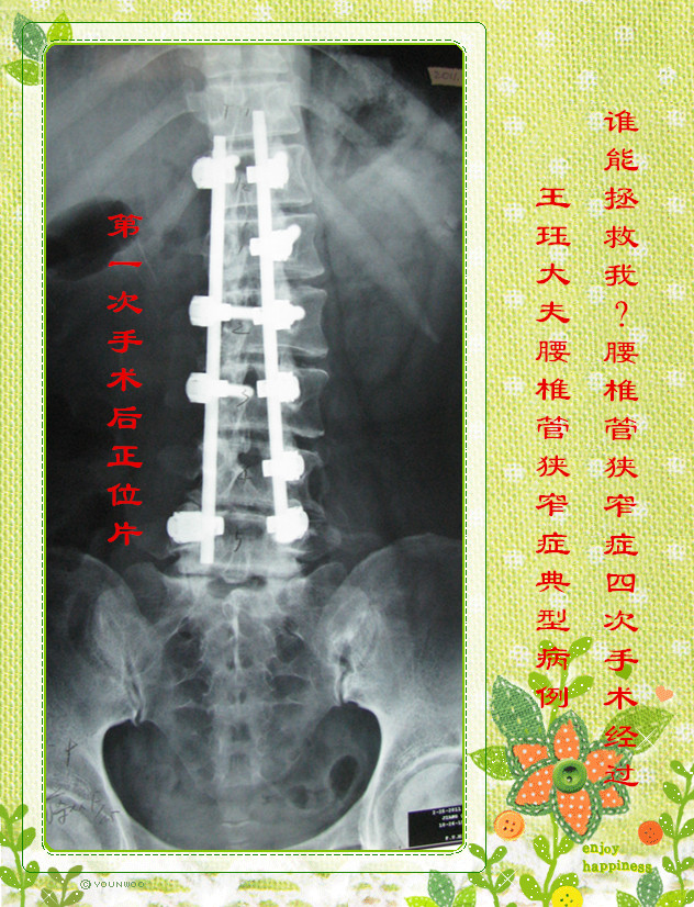 9年间先后在北京协和医院行三次腰椎手术,第一次行腰椎侧凸畸形内固定