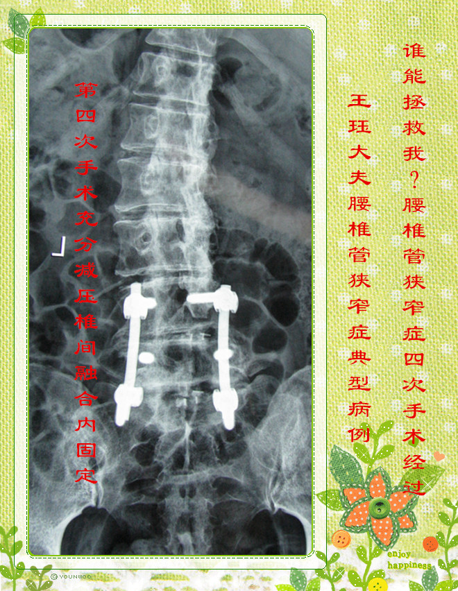 9年间先后在北京协和医院行三次腰椎手术,第一次行腰椎侧凸畸形内固定