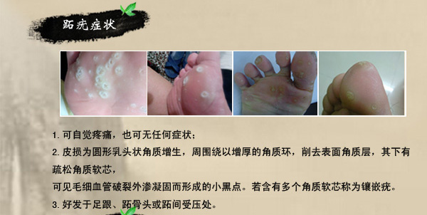 怎样去除瘊子不反复