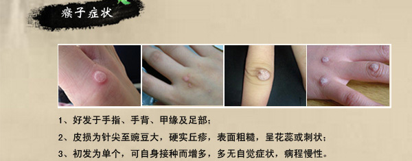 怎样去除瘊子不反复