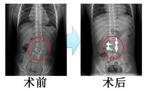 于我徐州市中心医院院就诊,拍片后诊断为先天性脊柱测凸,半椎体畸形