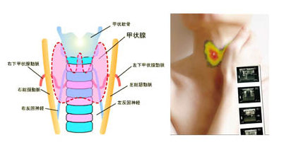 甲状腺炎在早期有什么症状
