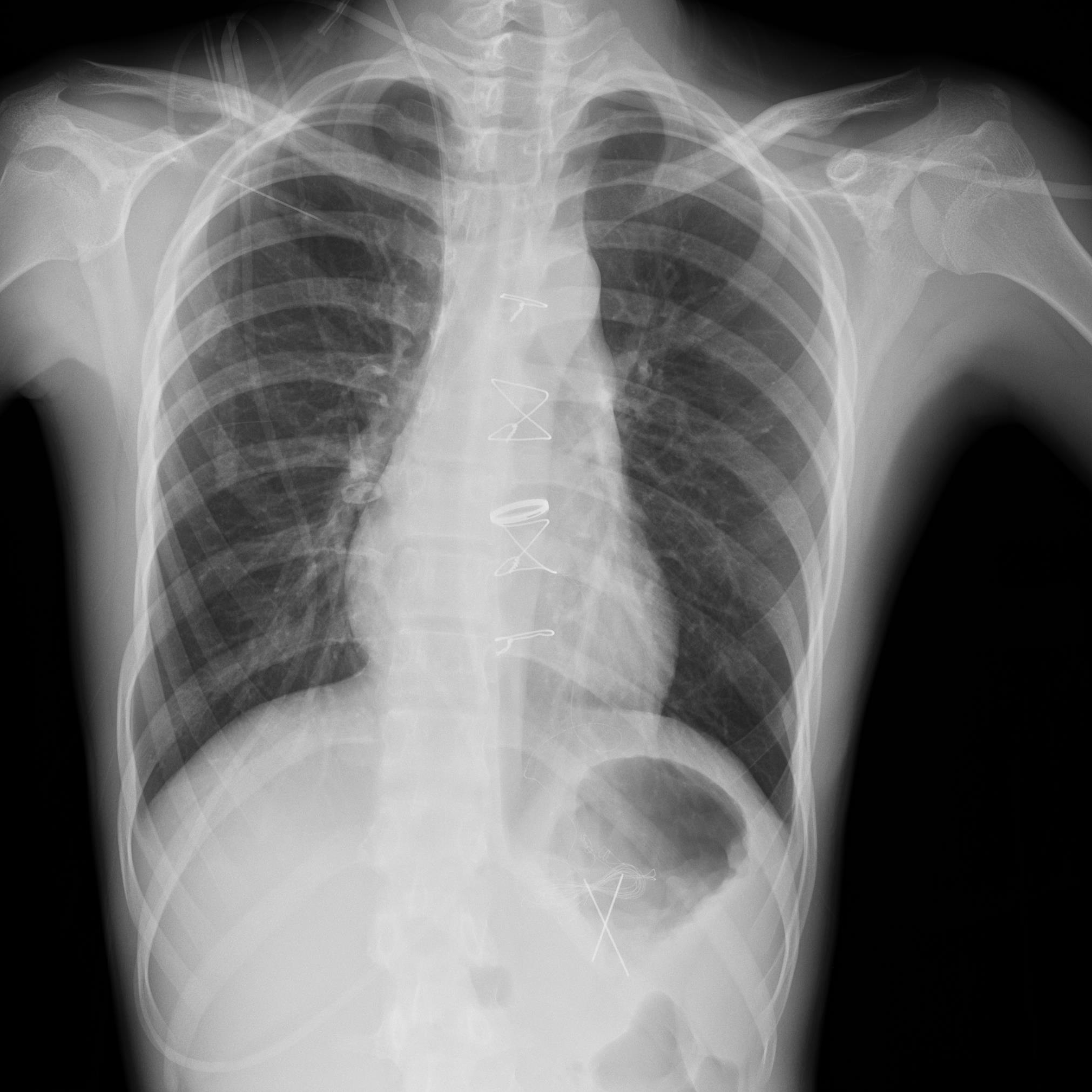 拍了胸片上面写的医嘱是复合型支气管炎左隔胸