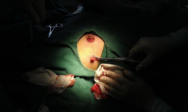 乳腺科二病区特色(一)乳腺良性肿瘤切口-看不到的"美容手术"
