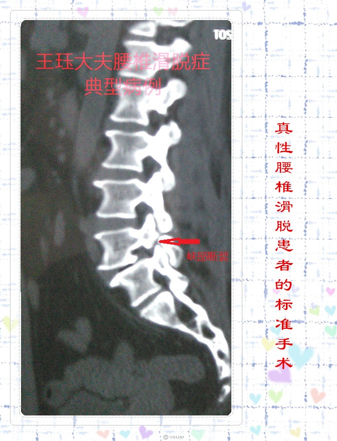 术前影像学资料可清楚显示椎体双侧峡部断裂,腰椎滑脱明显,术后显示