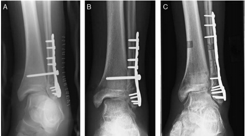 可以更好的评估下胫腓关节的复位和骨折 图 2(a)20 岁男性外踝骨折