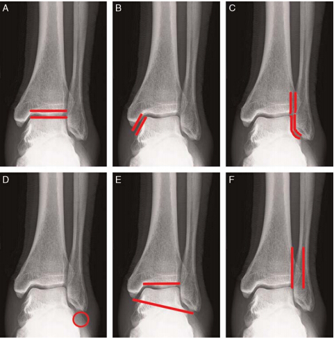 手术治疗45例踝关节骨折体会分析