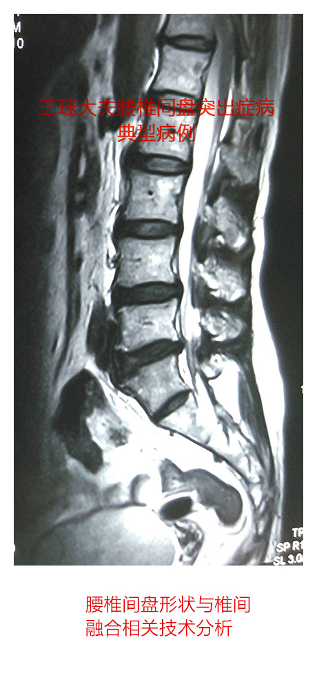 病例89:腰椎间盘形状与椎间融合相关技术分析