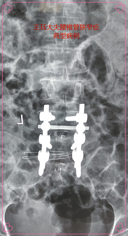 病例90:一位乳腺癌术后的腰椎管狭窄症患者成功手术的