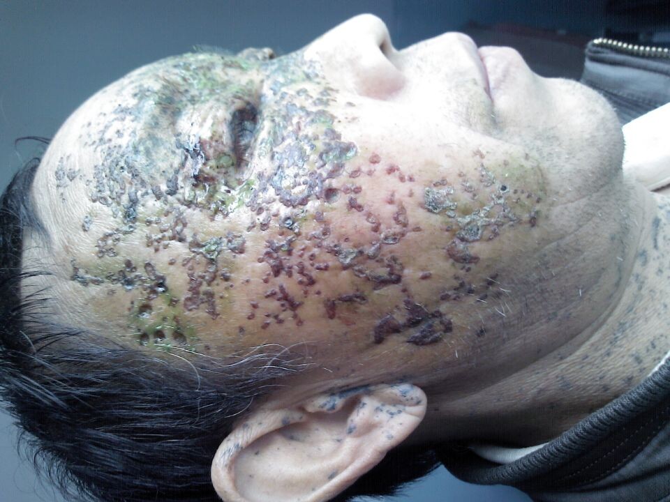 意外粉粒沉着(Accidenal Tattoos)_吕梁市人民医院薛柳平_寻医问药专家网