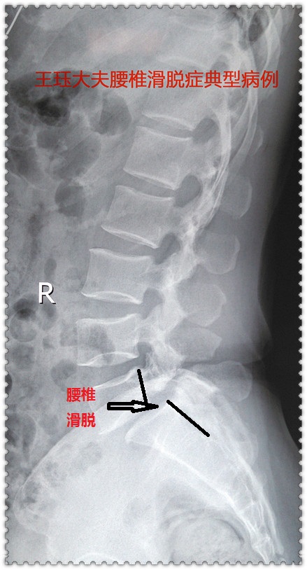 腰椎滑脱手术可以报销吗 腰椎滑脱保险报销吗