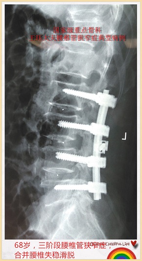 病例109:68岁,三阶段腰椎管狭窄症,合并腰椎失稳滑脱