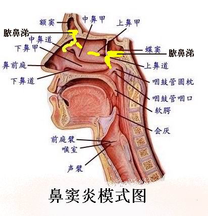 过敏性鼻炎的并发症之四——鼻窦炎