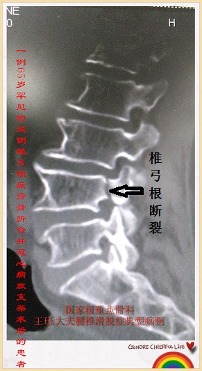 腰4椎弓根断裂,腰椎滑脱,合并冠心病支架置放术后,术前经调整抗凝药物