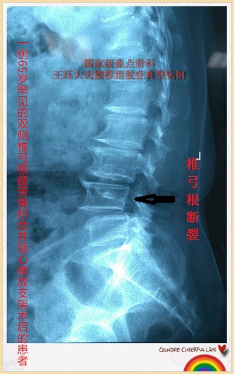 病例112:65岁罕见双椎弓根疲劳骨折并冠心病放支架术后患者