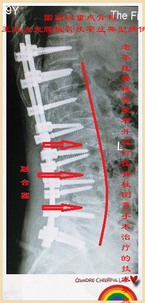 病例121:老年性腰椎管狭窄并退行性脊柱侧弯治疗的技术要点