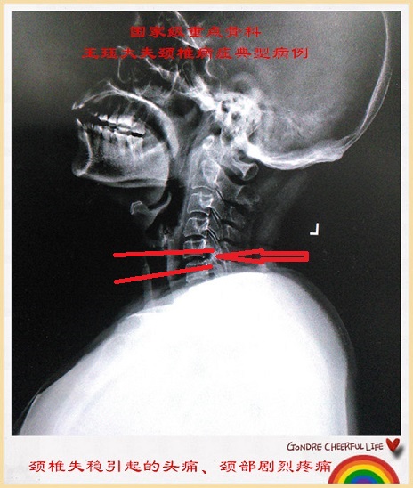 病例29:颈椎失稳引起的头痛,颈部剧烈疼痛