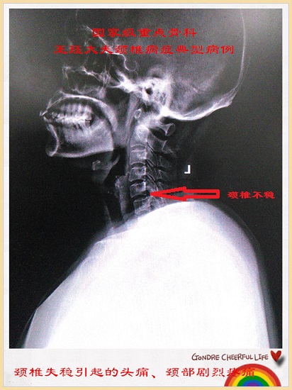 病例29:颈椎失稳引起的头痛,颈部剧烈疼痛