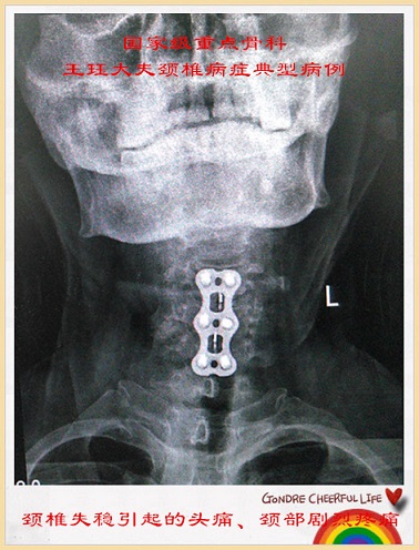 病例29:颈椎失稳引起的头痛,颈部剧烈疼痛