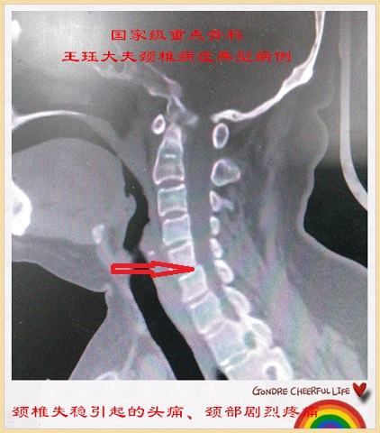 病例29:颈椎失稳引起的头痛,颈部剧烈疼痛