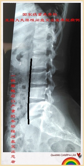 病例125:一例腰椎后凸严重的年轻椎间盘突出患者