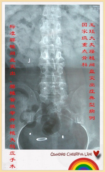 病例126:标准腰椎间盘突出,腰椎管狭窄并腰椎失稳症手术