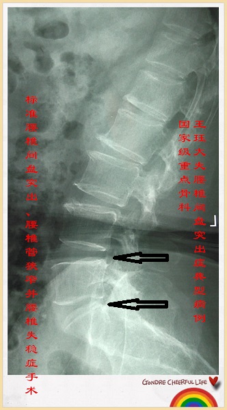 病例126:标准腰椎间盘突出,腰椎管狭窄并腰椎失稳症手术