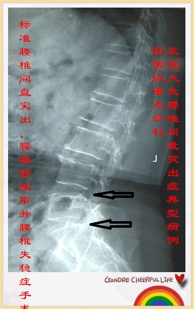 病例126:标准腰椎间盘突出,腰椎管狭窄并腰椎失稳症手术