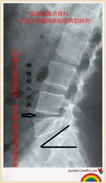 4,5椎间盘突出,合并腰5椎体峡部裂,真性腰椎滑脱,骶椎隐性脊柱裂患者