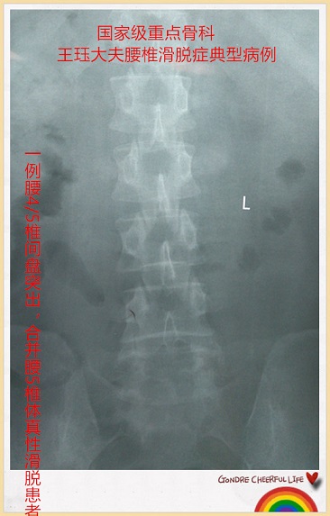5椎间盘突出,合并腰5椎体峡部裂,真性腰椎滑脱,骶椎隐性脊柱裂患者,得