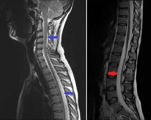 脊髓 mri t2wi 示脊髓 l2–s2 水平前部硬膜外及 t1–9,c1-2 水平后