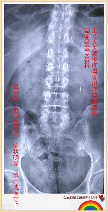 病例133:磁共振:椎间盘膨出,症状明显,手术或保守?
