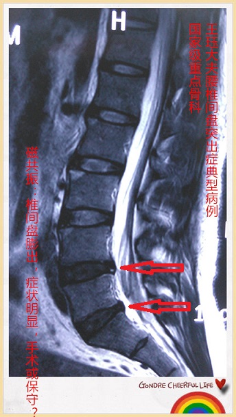 中央型腰椎间盘突出有大小便功能障碍者      ● 合并明显的