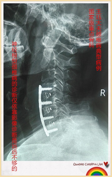 病例35:神经根型颈椎病的诊断仅依靠影像诊断