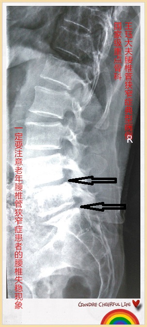 病例138:一定要注意老年腰椎管狭窄症患者的腰椎失稳现象