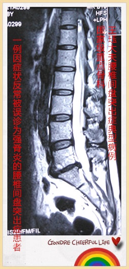 病例144:一例因症状反常被误诊为强脊炎的腰椎间盘突出症患者