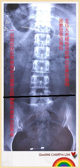 病例144:一例因症状反常被误诊为强脊炎的腰椎间盘突出症患者